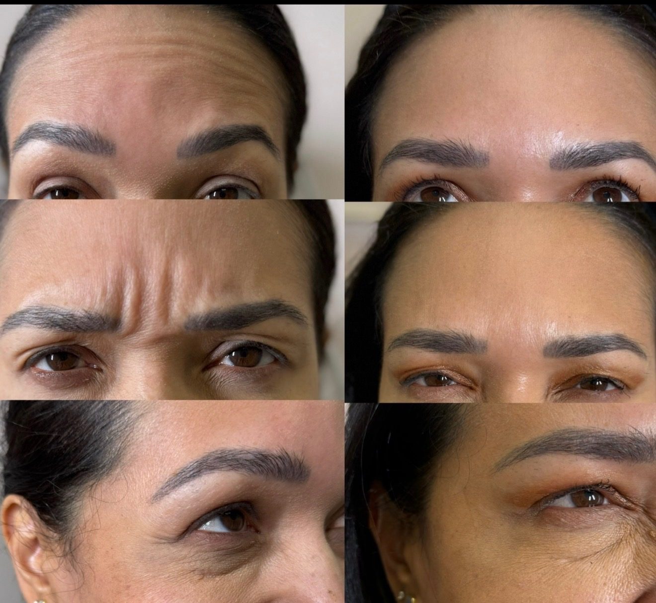 Wrinkle relaxer results — before and after
