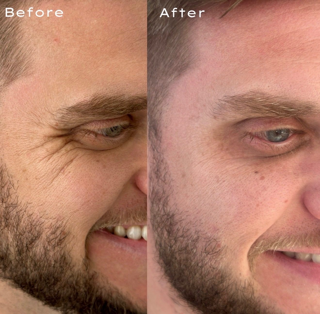Crow's feet — male patient — before and after