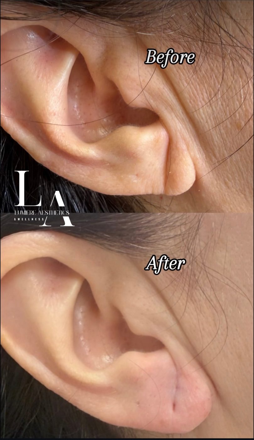Earlobe treatment — before and after
