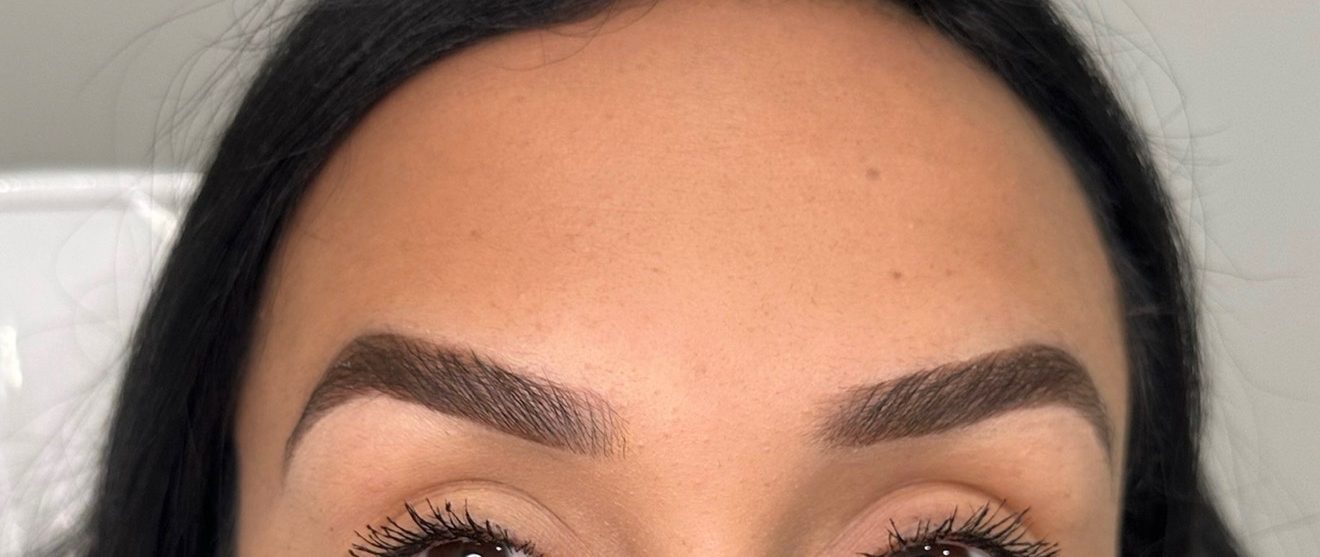 Forehead lines — after