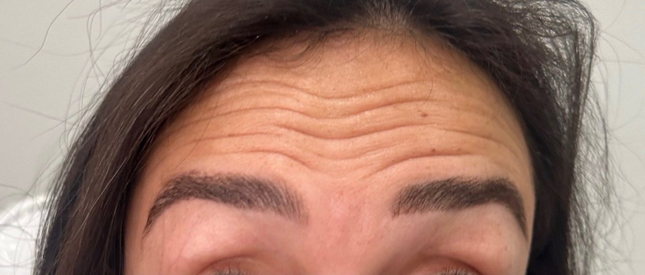 Forehead lines — before