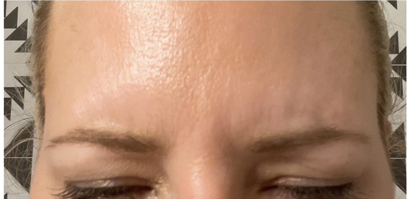 Frown lines — after