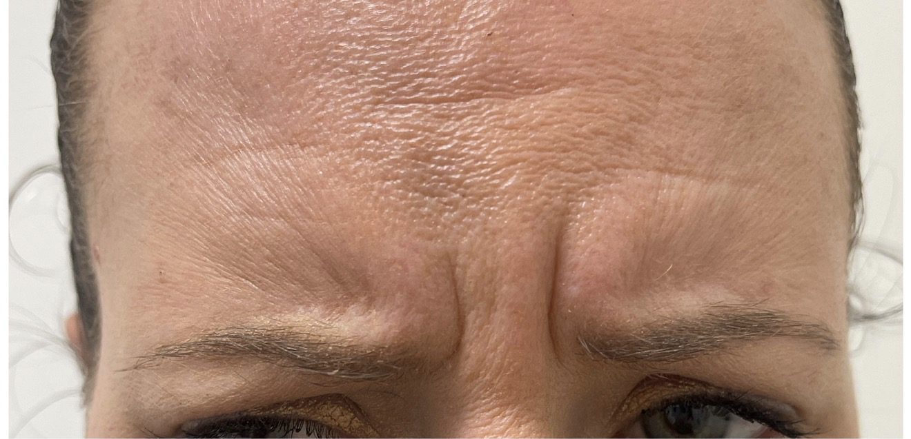 Frown lines — before