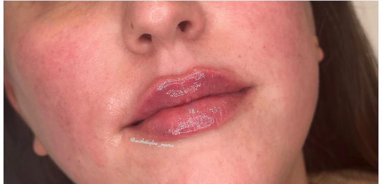 Lip filler — after