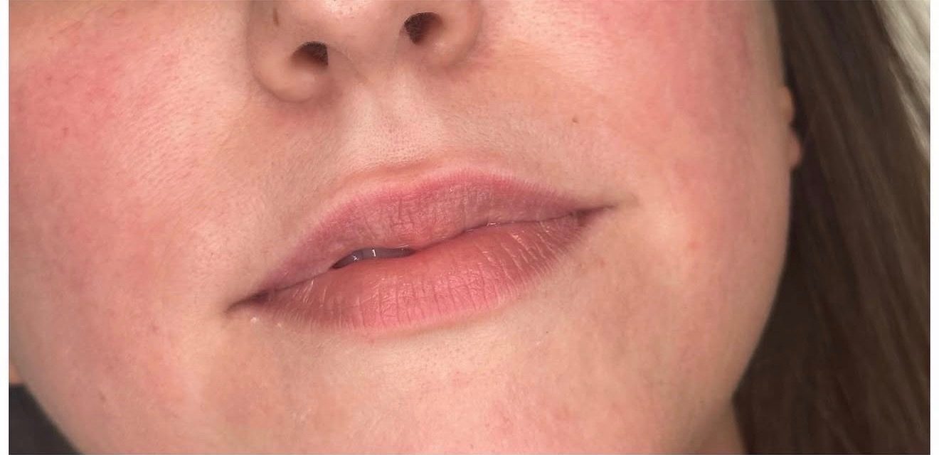 Lip filler — before
