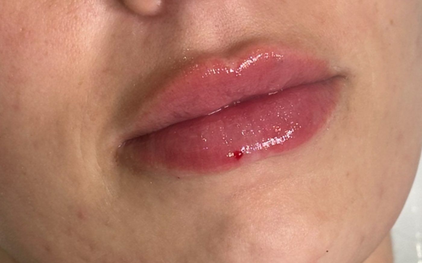 Lip filler — after