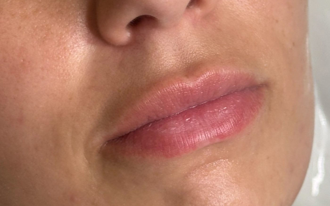 Lip filler — before