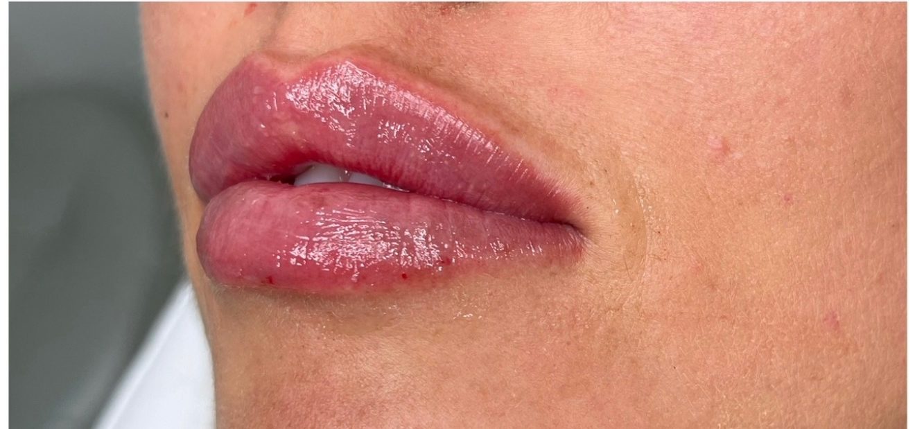 Lip filler — after