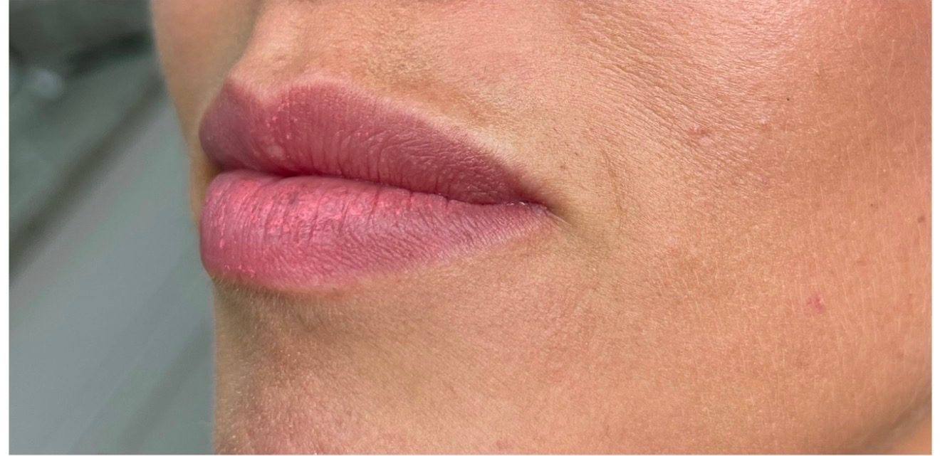Lip filler — before