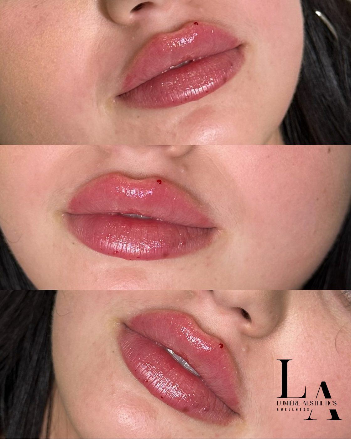 Lip filler — before and after