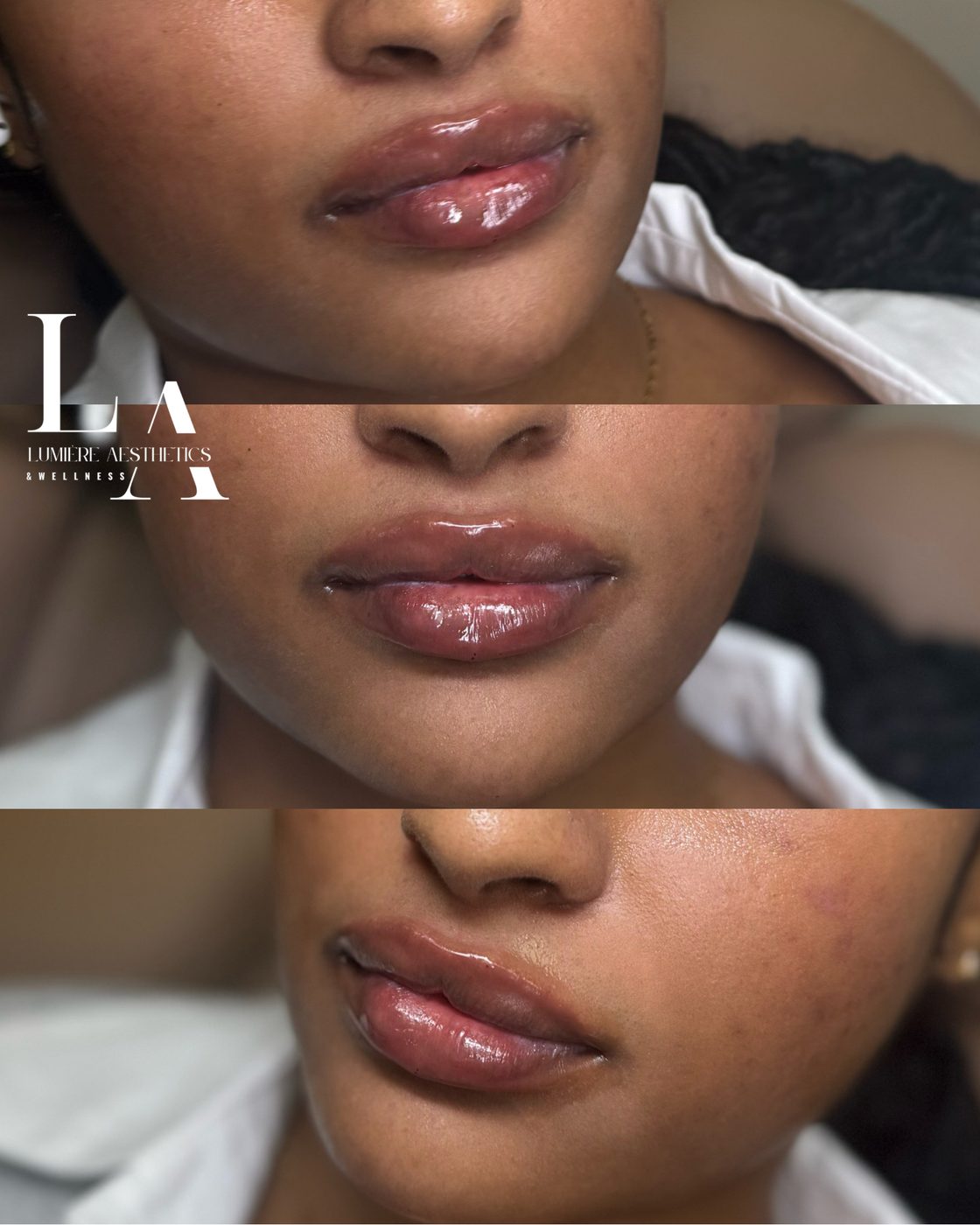 Lip filler — before and after