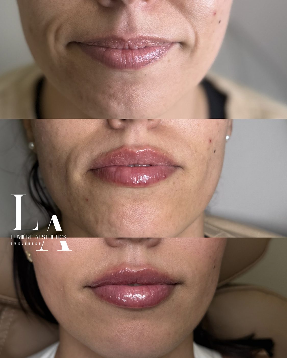 Lip filler — before and after