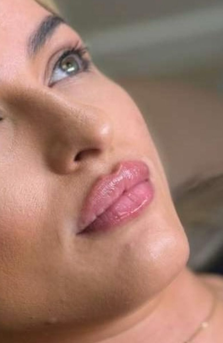 Lip filler — after