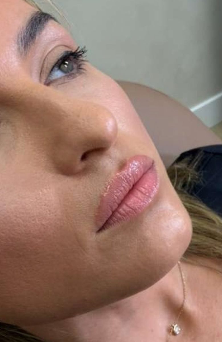 Lip filler — before