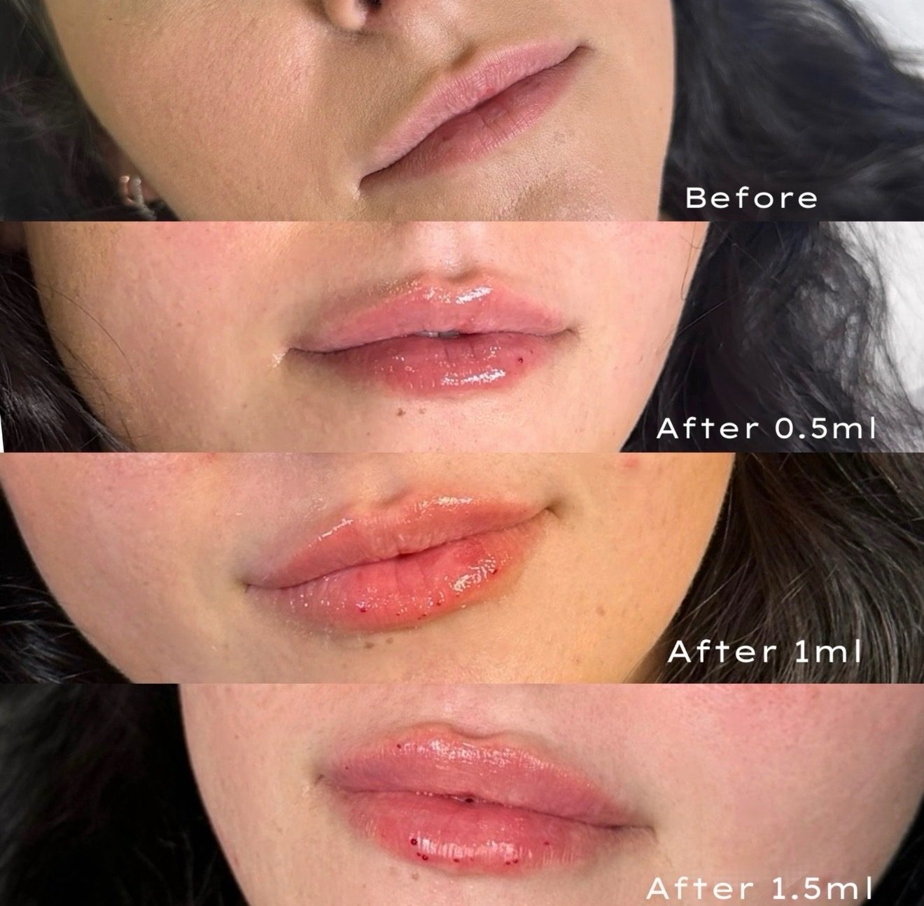 Lip filler — gradual progression — before and after