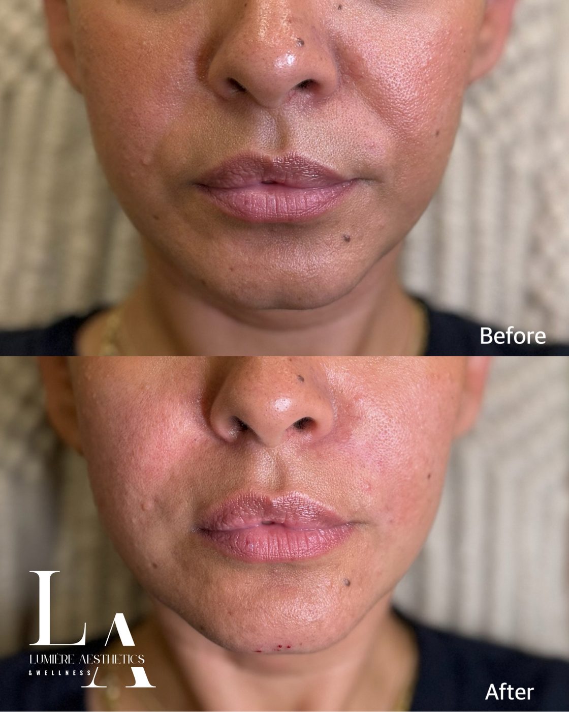 Facial balancing — lower face — before and after