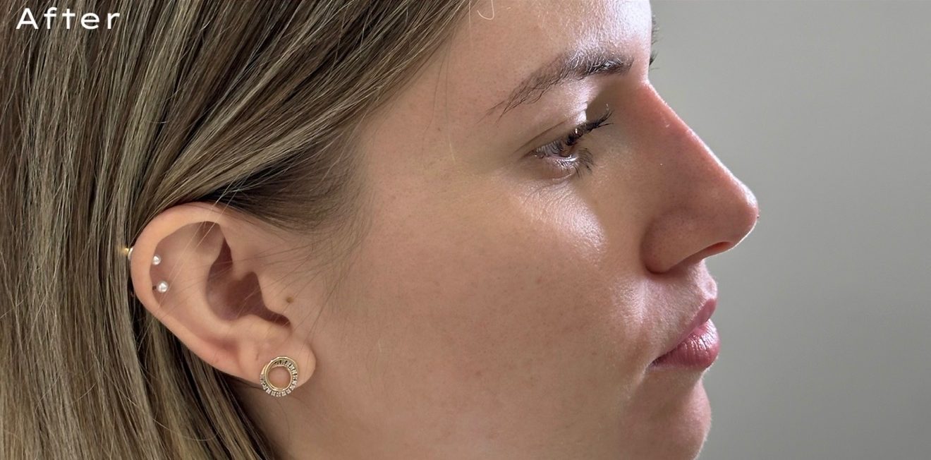Non-surgical rhinoplasty — after