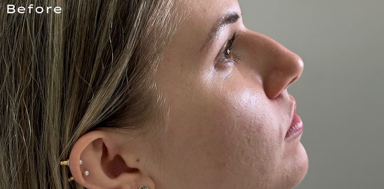 Non-surgical rhinoplasty — before