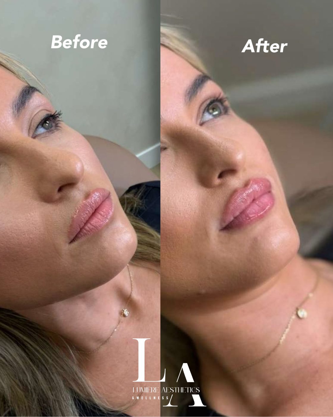 Facial balancing — profile — before and after
