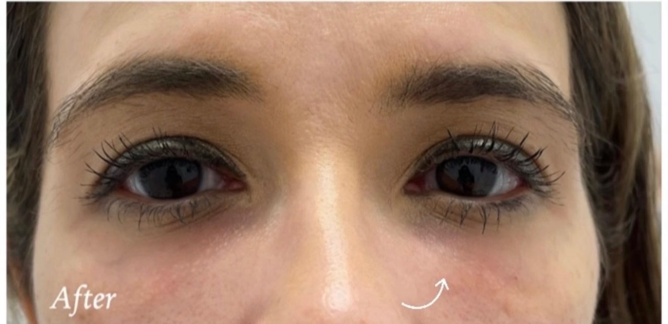 Under-eye filler — after