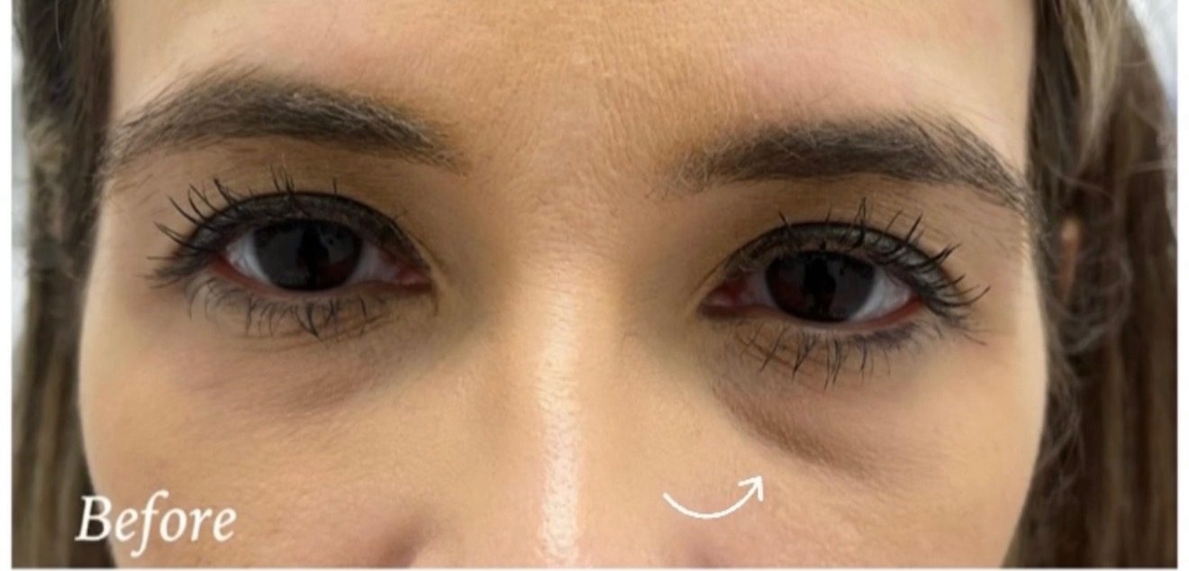 Under-eye filler — before